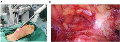 TransOral Endoscopic Thyroidectomy via Submental and Vestibular Approach: A Preliminary Report